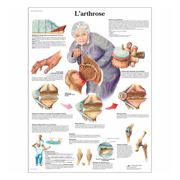 Chart "L'arthrose"