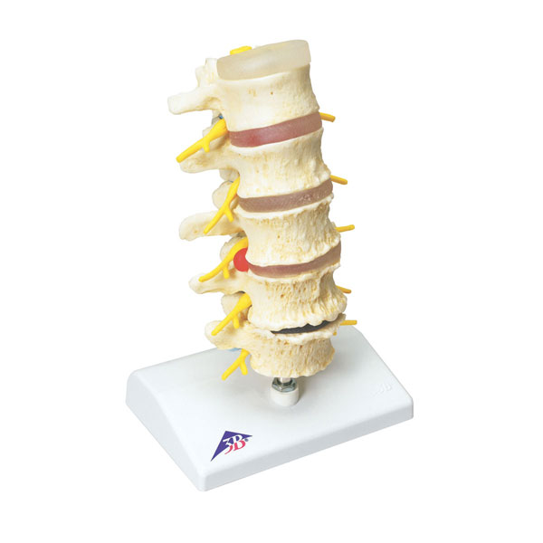 Stages of vertebral degeneration