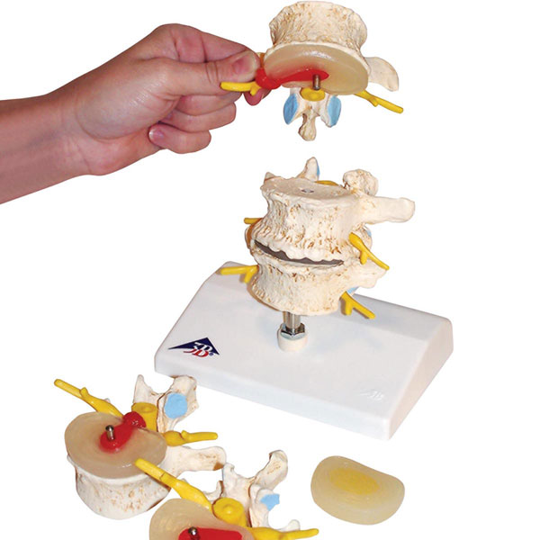 Stages of vertebral degeneration