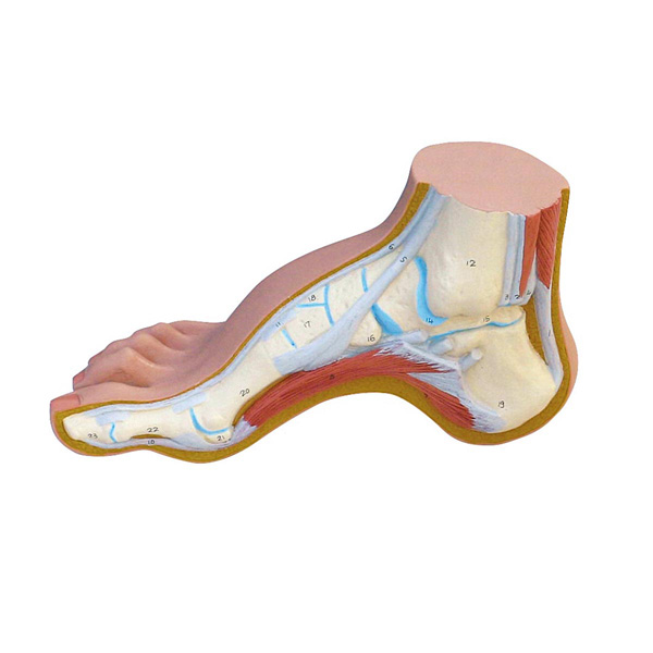 Functional hollow foot model (Pes Cavus)